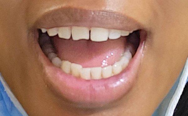 Chipped tooth