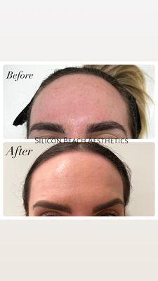 The Perfect Derma Peel & Botox brow lift