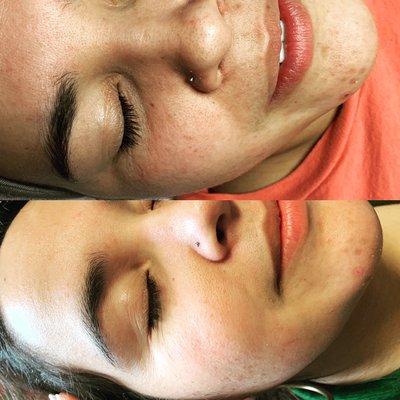 Before and After- Blueberry Jessner Peel. Working on hyperpigmentation and acne scars.