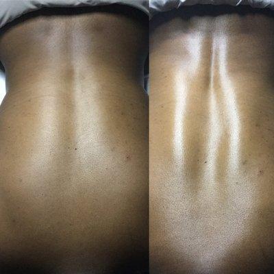 Back Facial: Before/After