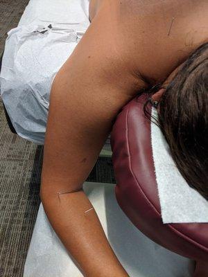 Shoulder and arm treatment