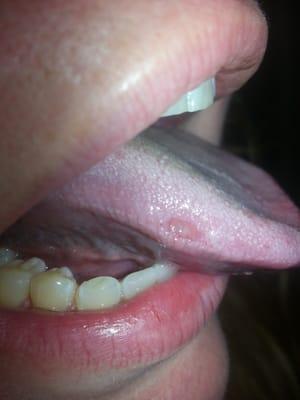 The hole they put in my tounge