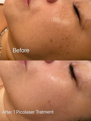 Pico Laser treatment