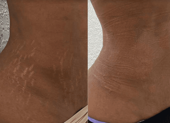 Skin Tightening and Laser Lipo