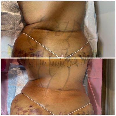 Lymphatic Drainage After Surgery