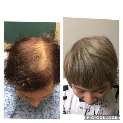 Female hair lost treatment