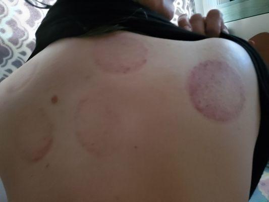 My first cupping experience was fantastic! I'll definitely be getting this done again..