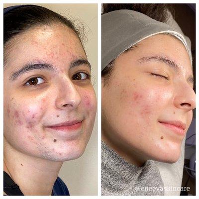 Face Reality Acne Bootcamp Skin progress with LED Light Therapy