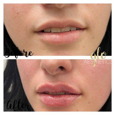 Lip fillers