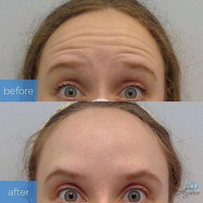 First-Time Dysport Before and After at Azura Skin Care Center Cary NC