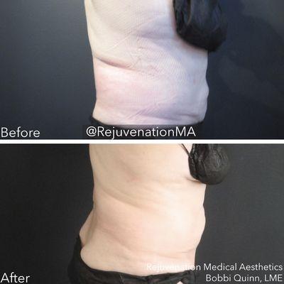 CoolSculpting Results