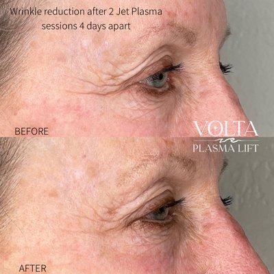 Wrinkle reduction after 2 Jet Plasma treatments, 4 days apart.