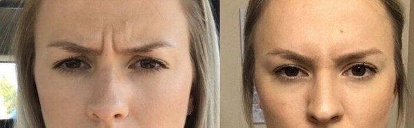 Before and after Botox to soften brow furrow