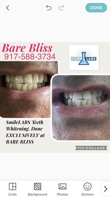 Our professional teeth whitening.