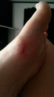 Photo makes the side of my foot look good as bad as it hurts today & this had no callus or anything on this area!