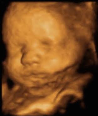 Life Meant to Live 3D/4D Ultrasound, Approximately 32 weeks gestation