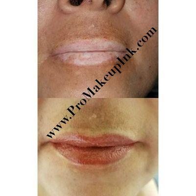 Vitiligo client desired natural color lips before and after taken immediately after procedure