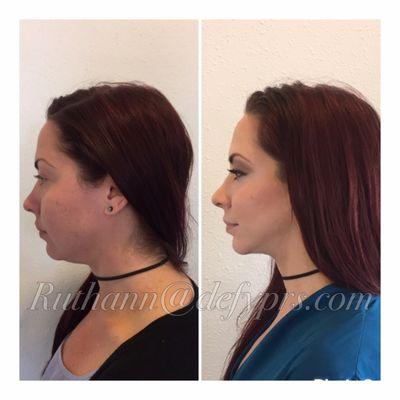 The Perfect Jawline with Kybella and Voluma