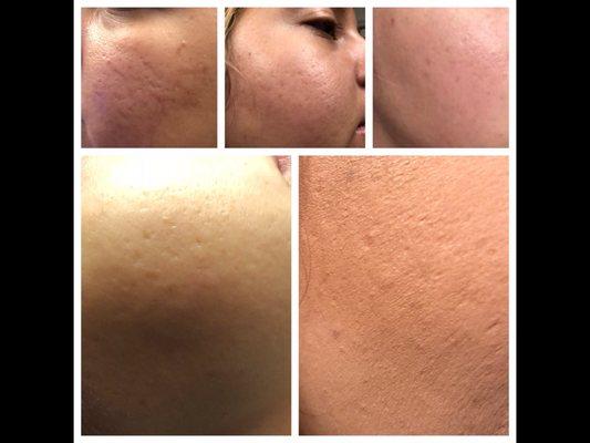 Microneedling to soften scars