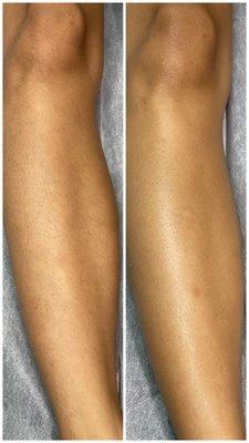 Full leg sugaring - before and after