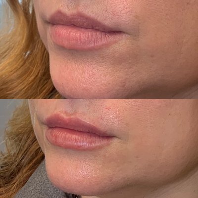 Juvederm ultra lip filler