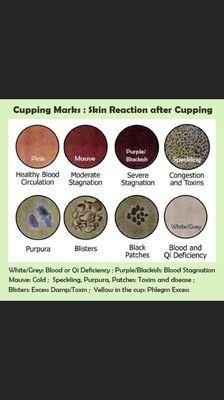 The Marks after cupping indicate the level of blood and Qi stagnation, toxin accumulation, or dampness accumulation in your body.