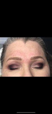 After brow procedure