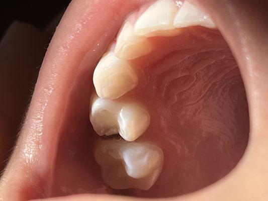 Very large cavity on the side of tooth