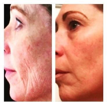 Our cutting edge facial leverages our Amniotic Allograft (AKA Stem Cells), from Axolotl Biologix to initiate regeneration, repair of skin.