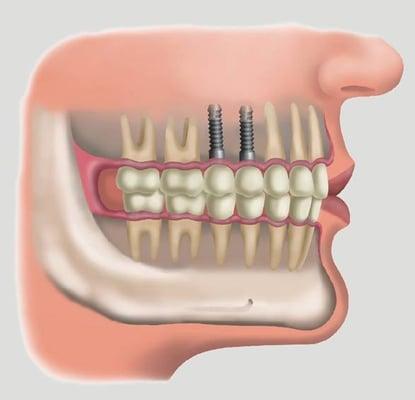 Dental Implants