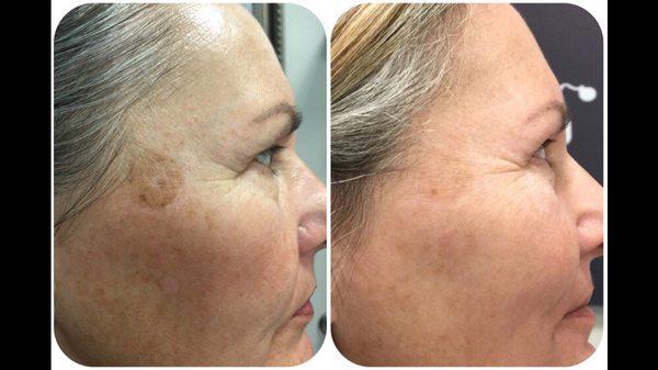 Chemical peels can really help improve skin and lighten hyperpigmentation and dark spots. Recommended in any antiaging regimen.