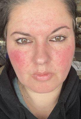 Before Natren probiotics... Rosacea flare up