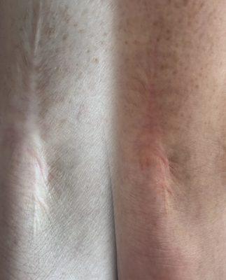 Improvement in scar puckering after just one session.