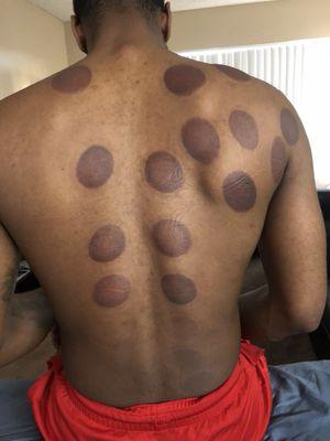 Cupping session with one of my NBA athletes!