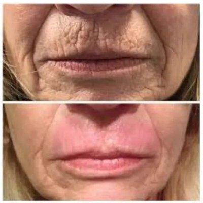 Plasma Pen Upper/Lower Lips Wrinkle Reduction 409-454-9502