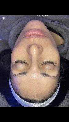 Hydra facial results!