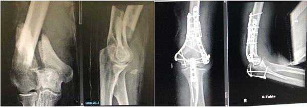 Intra-articular distal humerus fracture  before and after surgical fixation with restoration of anatomy.