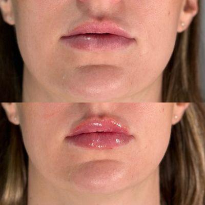 Before and after lips