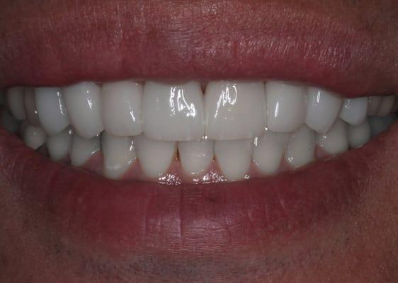 After: 8 Porcelain Crowns/Veneers