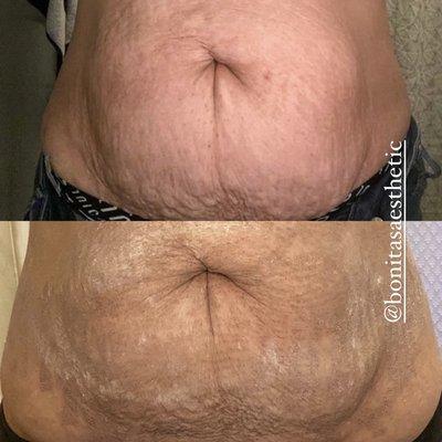 Under belly lift 1 session working to get rid of stretch marks and lose skin