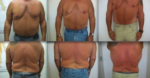 Actual Patient:  LipoMELT using Cutera Titan and Mesotherapy. Non-surgical Body Contouring option.