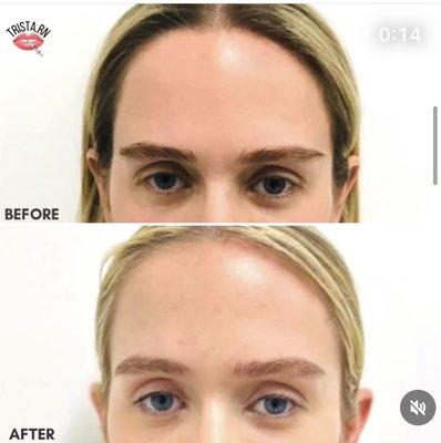 Eyebrow lift using Threads