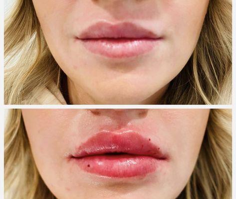 Before and After Lip Injections