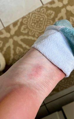 Left foot injured during pedicure