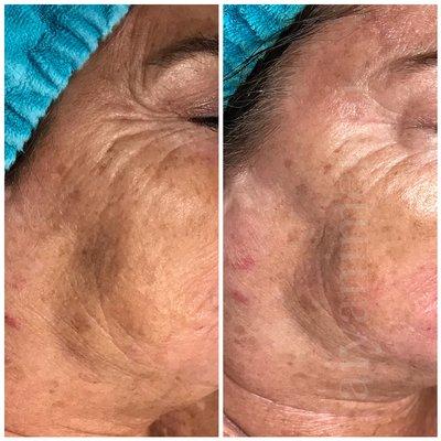 One facial with great results.