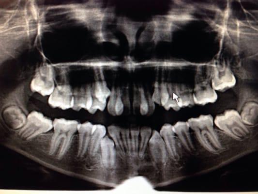 11 YO . Starting braces sooner than later to utilize the patient's growth to increase archlength; avoiding extracting 4 teeth.