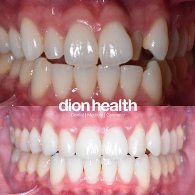 before and after of clear aligners ortho treatment