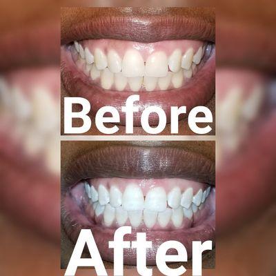 Teeth whitening