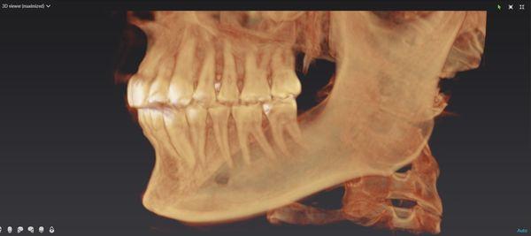 CBCT reconstruction of Dr.Randall Ewing's dentition (teeth) and surrounding structures