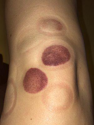 Cupping session on the knee. As you can see, there's a lot of stagnation in the darker colors.